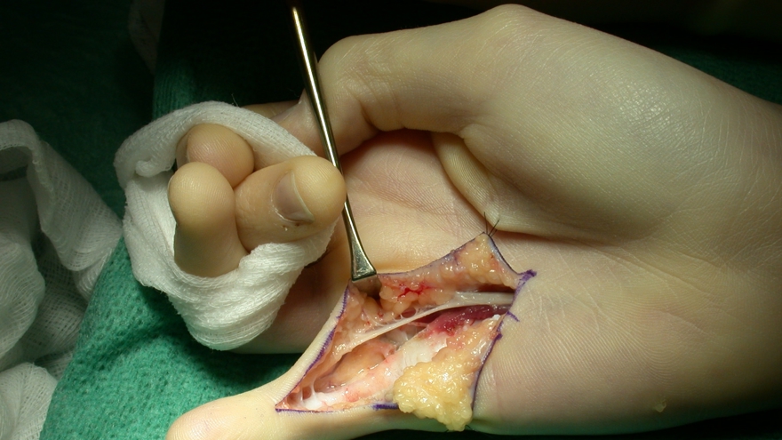 Bild som visar en operation av flexorsenskada i zon II.