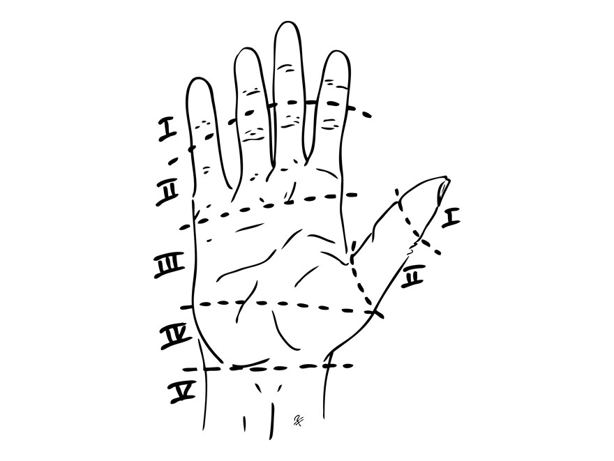 Svart och vit illustration över zonindelning för flexorsenskador inom handkirurgin tecknat av Per Fredrikson.