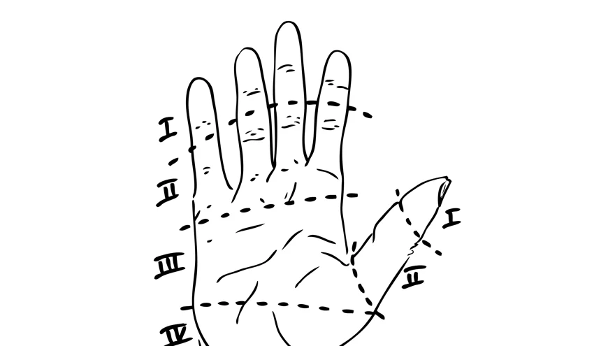 Svart och vit illustration över zonindelning för flexorsenskador inom handkirurgin tecknat av Per Fredrikson.