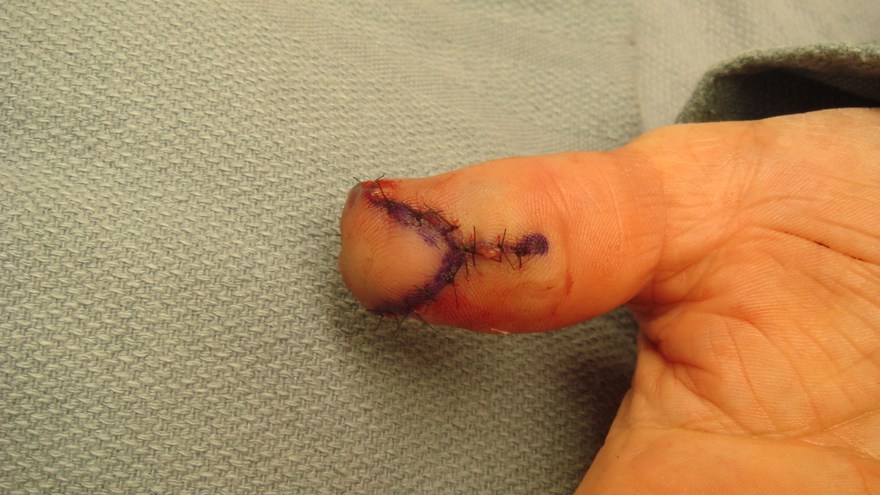 ) Volarsidan, enstaka suturer. V-snittet har blivit ett Y