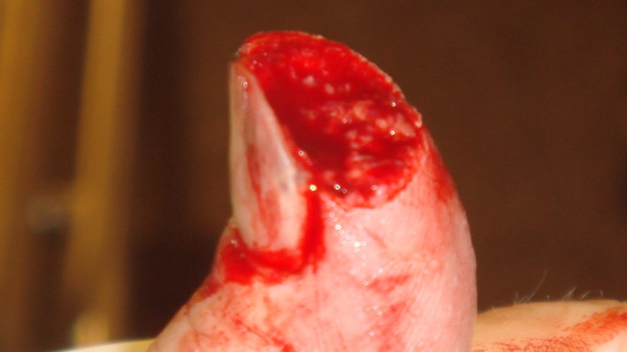 En typisk skärskada.