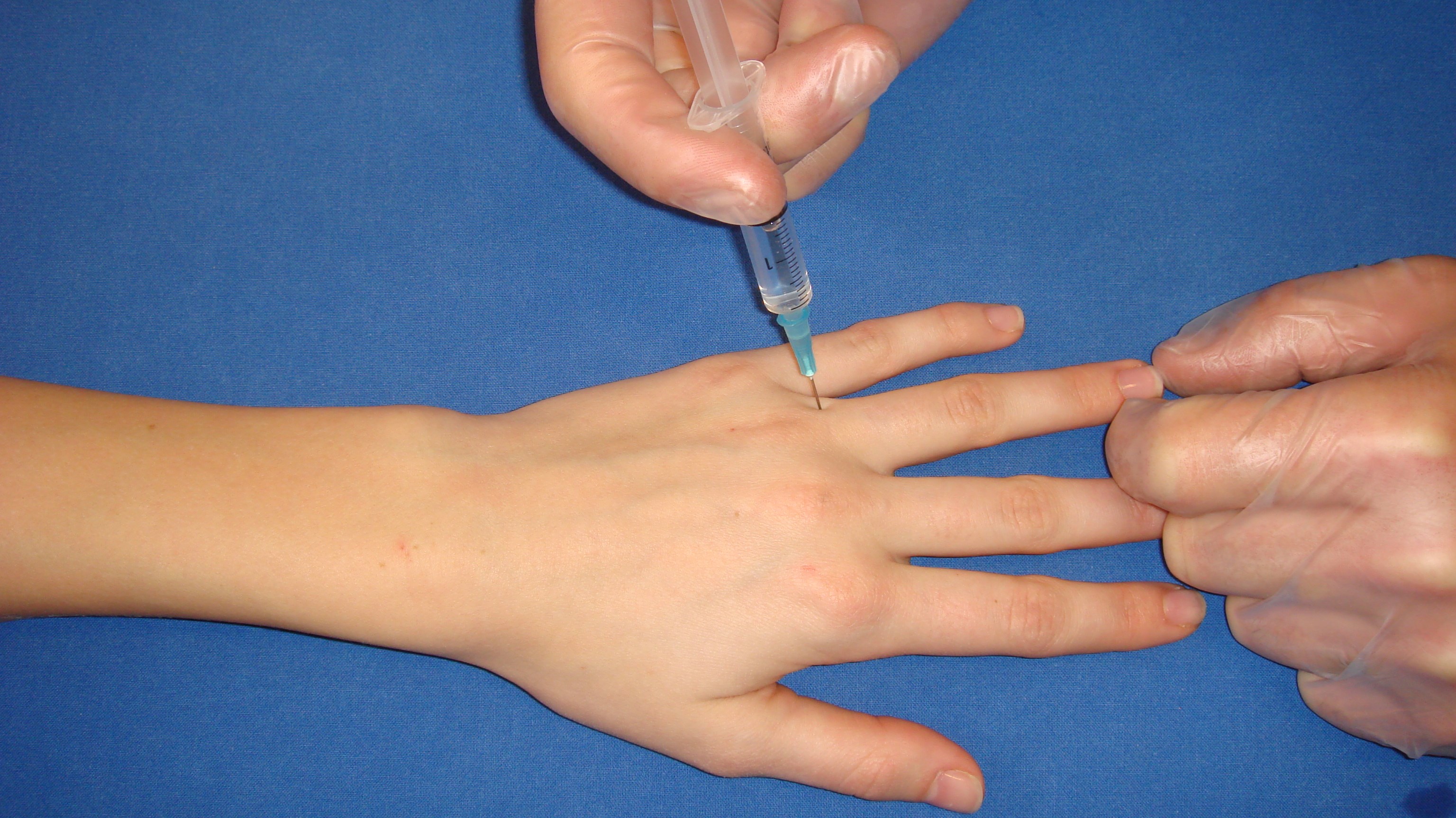 Digitalnerverna löper på vardera sidan om benet och volart. Blockaden skall läggas proximalt om böjvecket för att undvika stas i vävnaden. Nålspetsen förs in ovanifrån, ca 0,5 ml injiceras på vardera sidan av fingret.