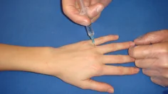 Digitalnerverna löper på vardera sidan om benet och volart. Blockaden skall läggas proximalt om böjvecket för att undvika stas i vävnaden. Nålspetsen förs in ovanifrån, ca 0,5 ml injiceras på vardera sidan av fingret.