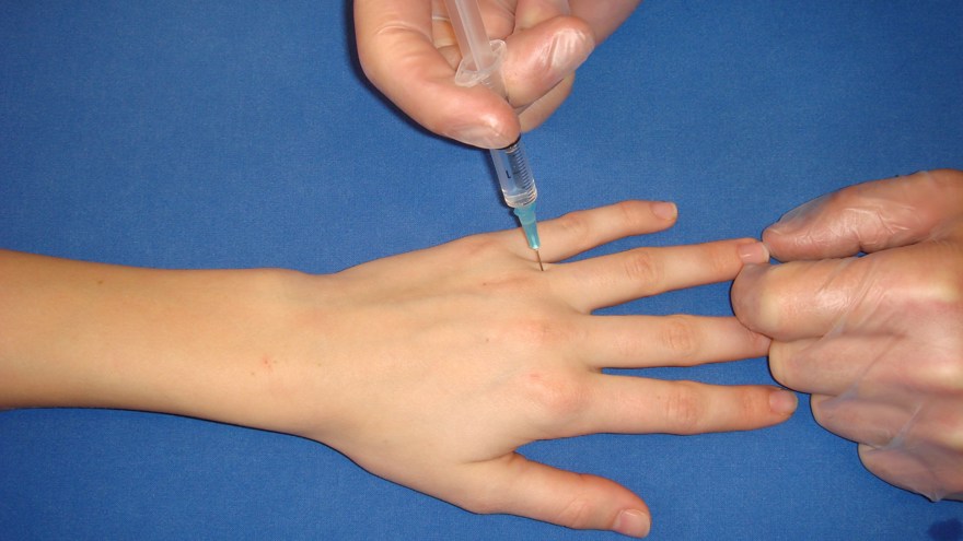 Digitalnerverna löper på vardera sidan om benet och volart. Blockaden skall läggas proximalt om böjvecket för att undvika stas i vävnaden. Nålspetsen förs in ovanifrån, ca 0,5 ml injiceras på vardera sidan av fingret.