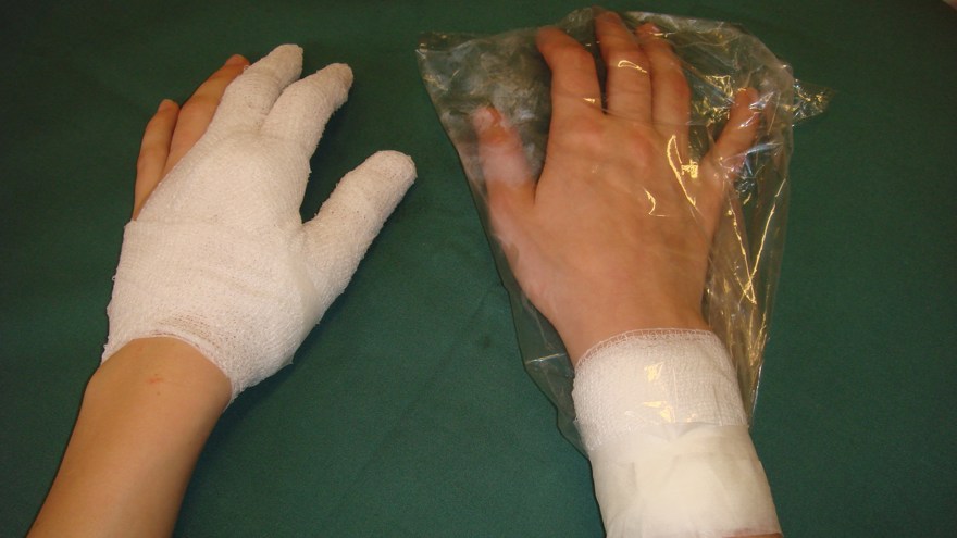 Slutresultatet. Till höger jämförande bild mellan initial behandling med påse och torrt förband.