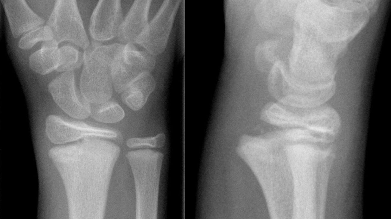 Salter-Harrys II (eller Aitken I) fraktur i den distala radien hos en 12-åring. Du kan se förskjutningen från metafys till epifys (sidovy) och den radiovolära frakturen av metafysen.