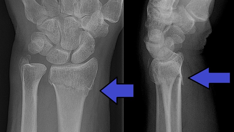 Röntgenbild av en Collesfraktur i vänster handled. En ulnar styloidfraktur syns också.