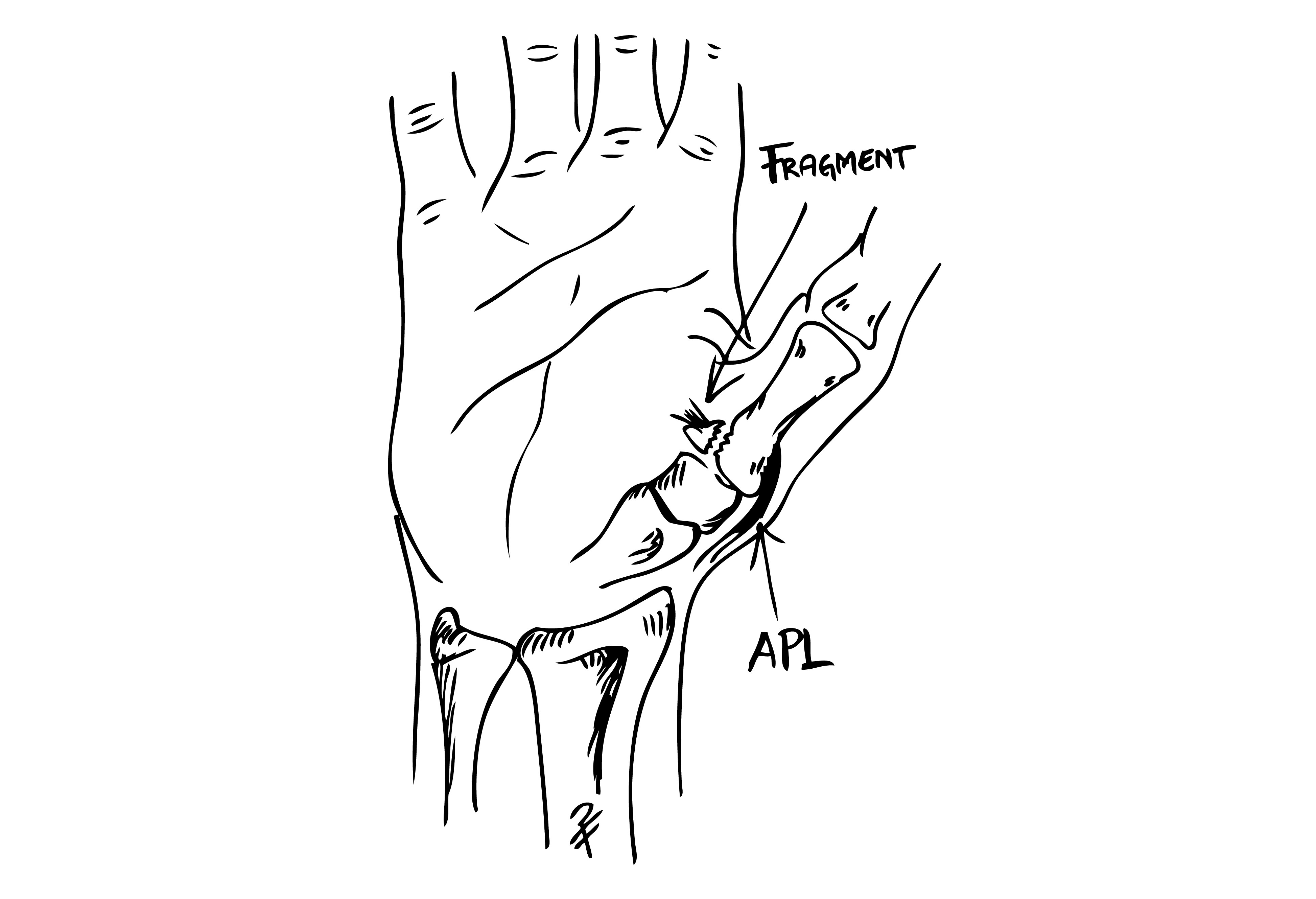 Svart och vit illustration över mekanism vid Bennet fraktur tecknat av Per Fredrikson