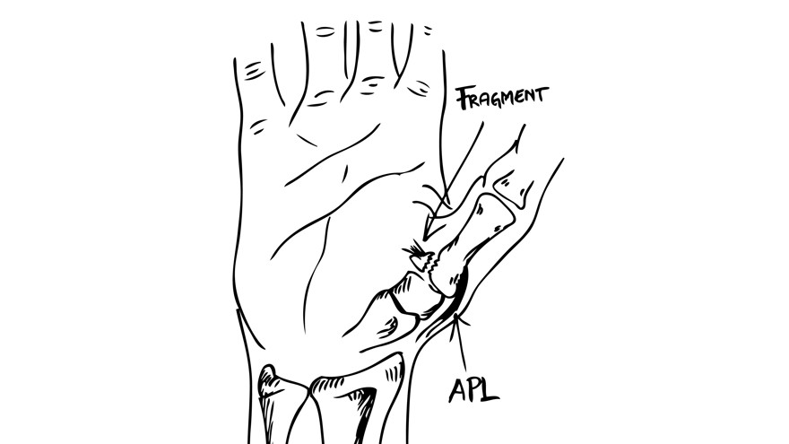 Svart och vit illustration över mekanism vid Bennet fraktur tecknat av Per Fredrikson