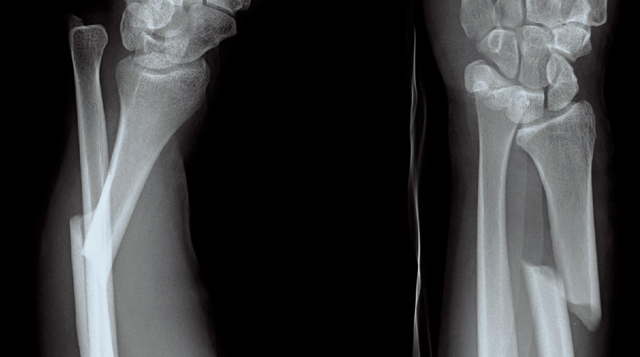 Röntgenbild som visar en fraktur av distala radien med dislokation av distala radioulnarleden.