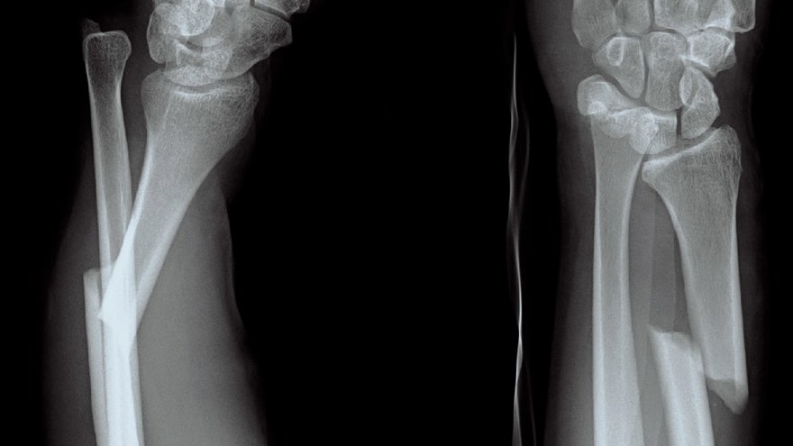Röntgenbild som visar en fraktur av distala radien med dislokation av distala radioulnarleden.