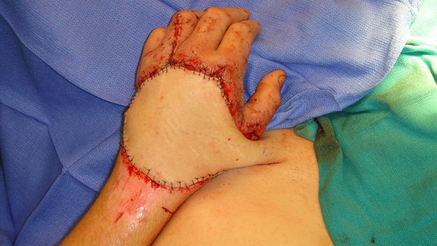 Ljumsklambå skapas från vänster höft