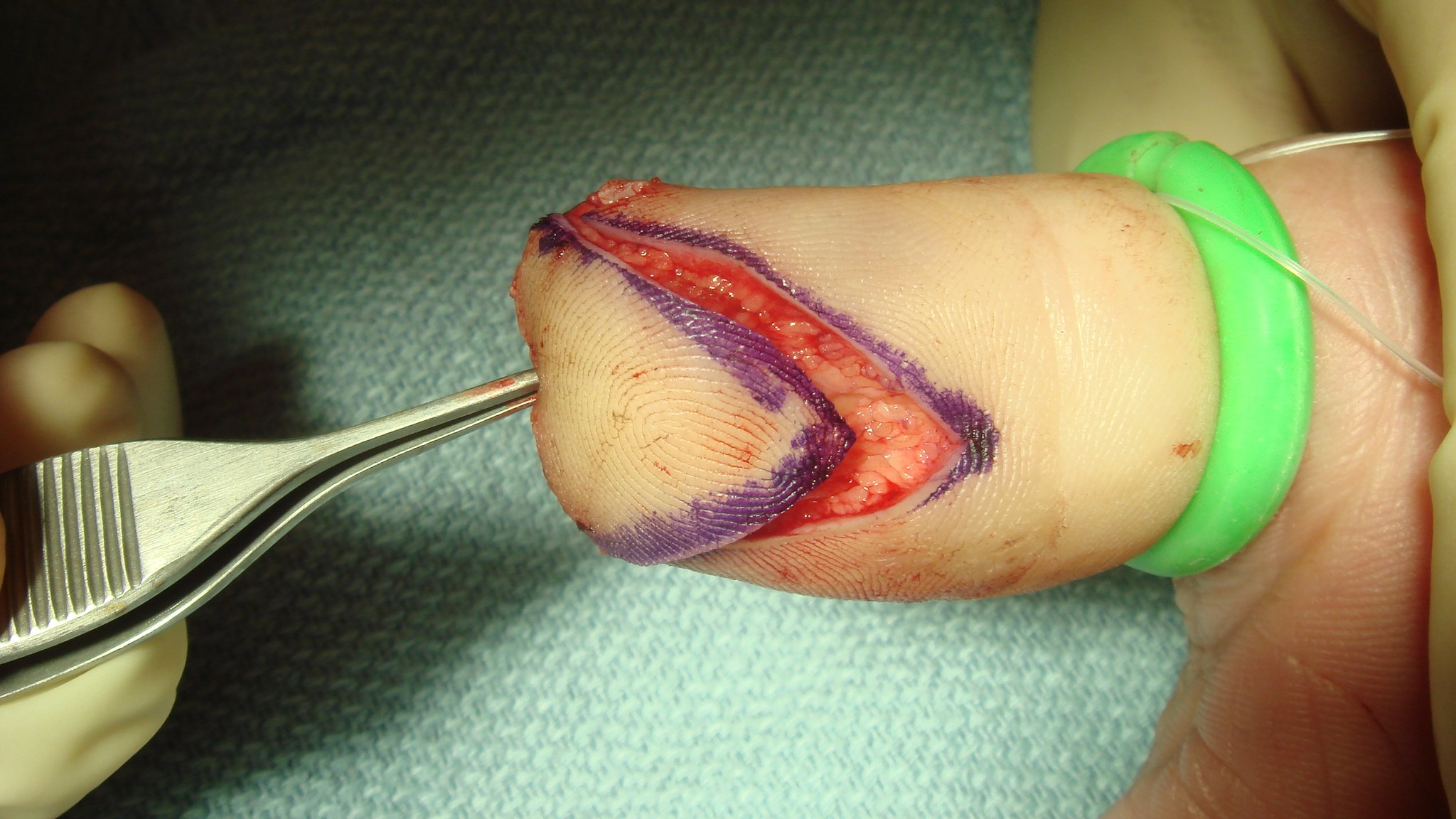 Traumatiserade kanterna trimmade, V-snittet lagt