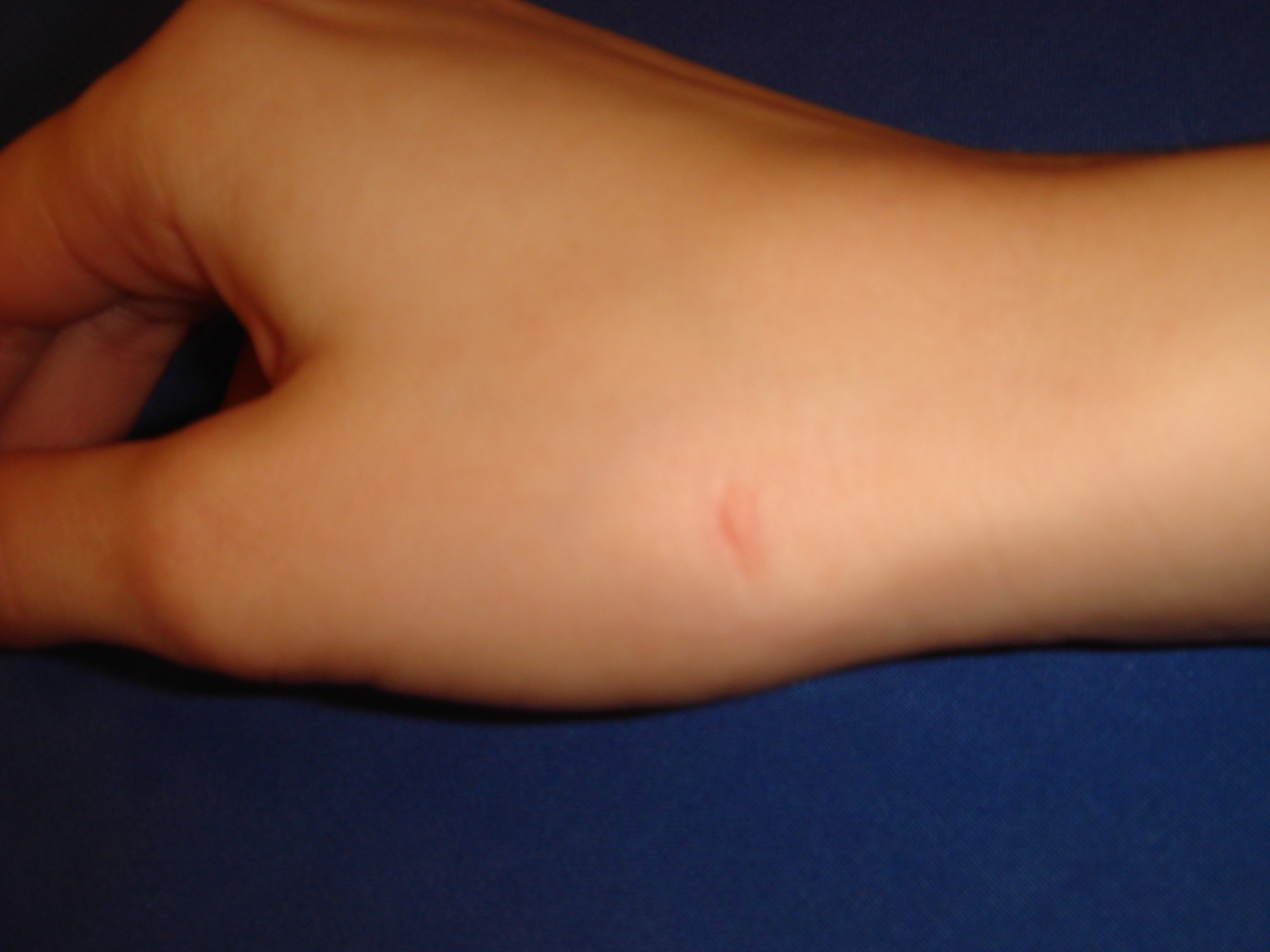 Markeringen på möjlig injektionsplats vid tumbasartros (CMC1 leden)