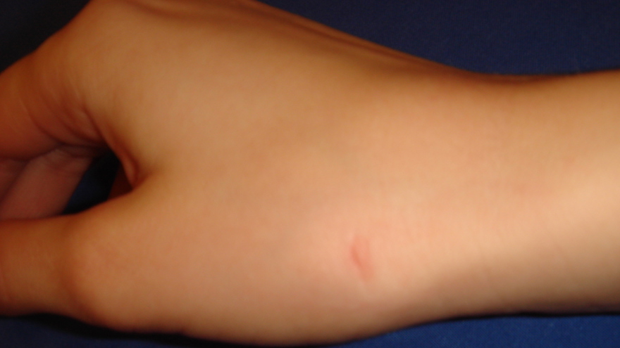 Markeringen på möjlig injektionsplats vid tumbasartros (CMC1 leden)