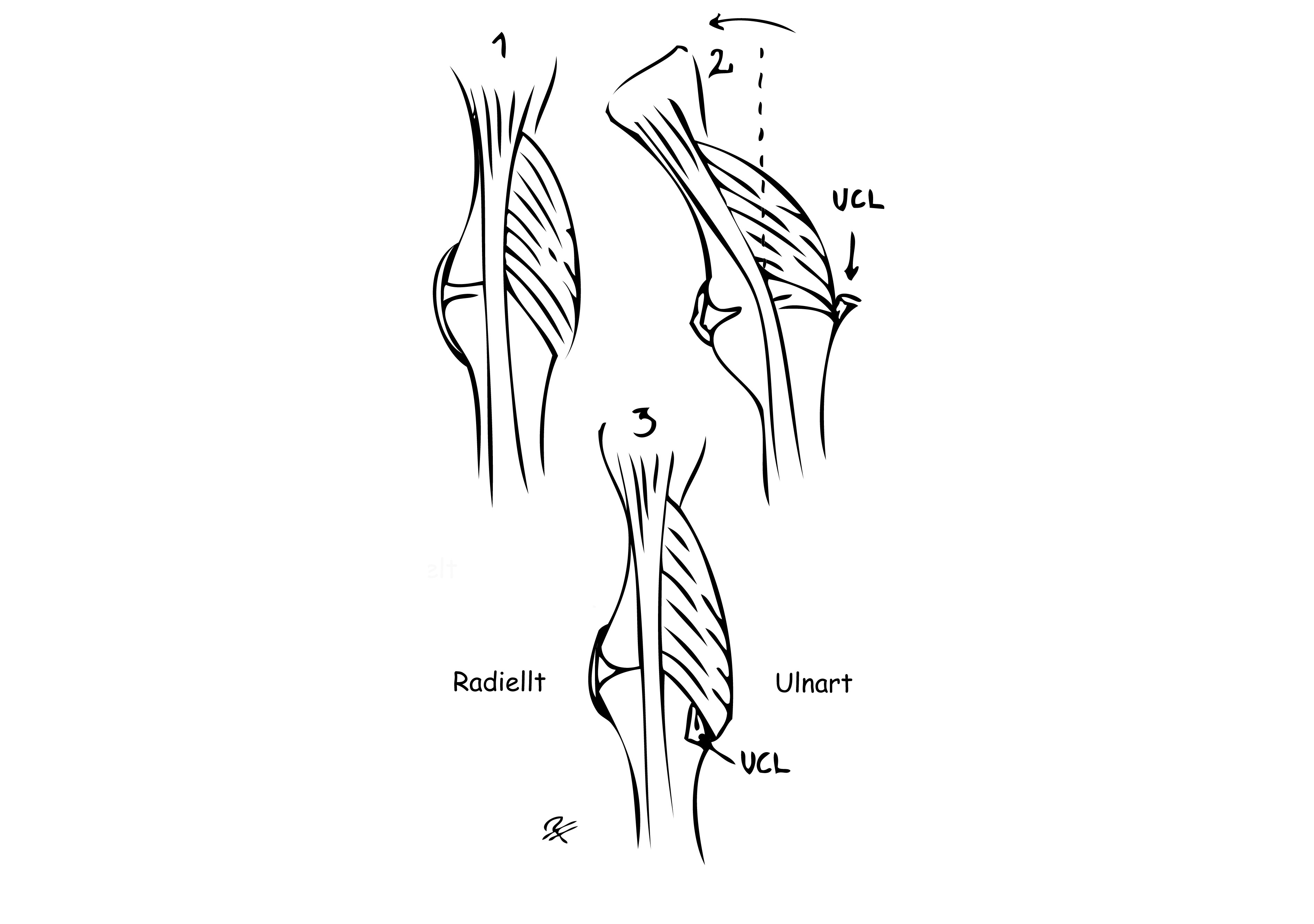 Svart och vit illustration över UCL-skada i tummens MCP-led