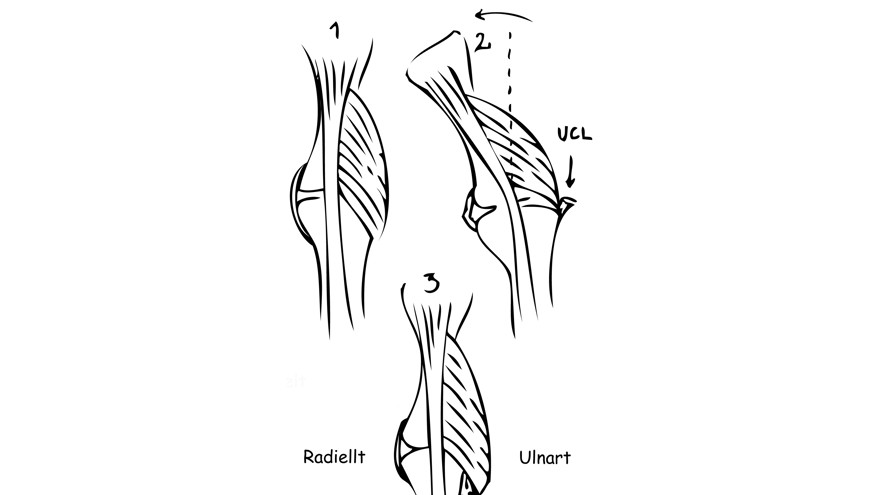 Svart och vit illustration över UCL-skada i tummens MCP-led