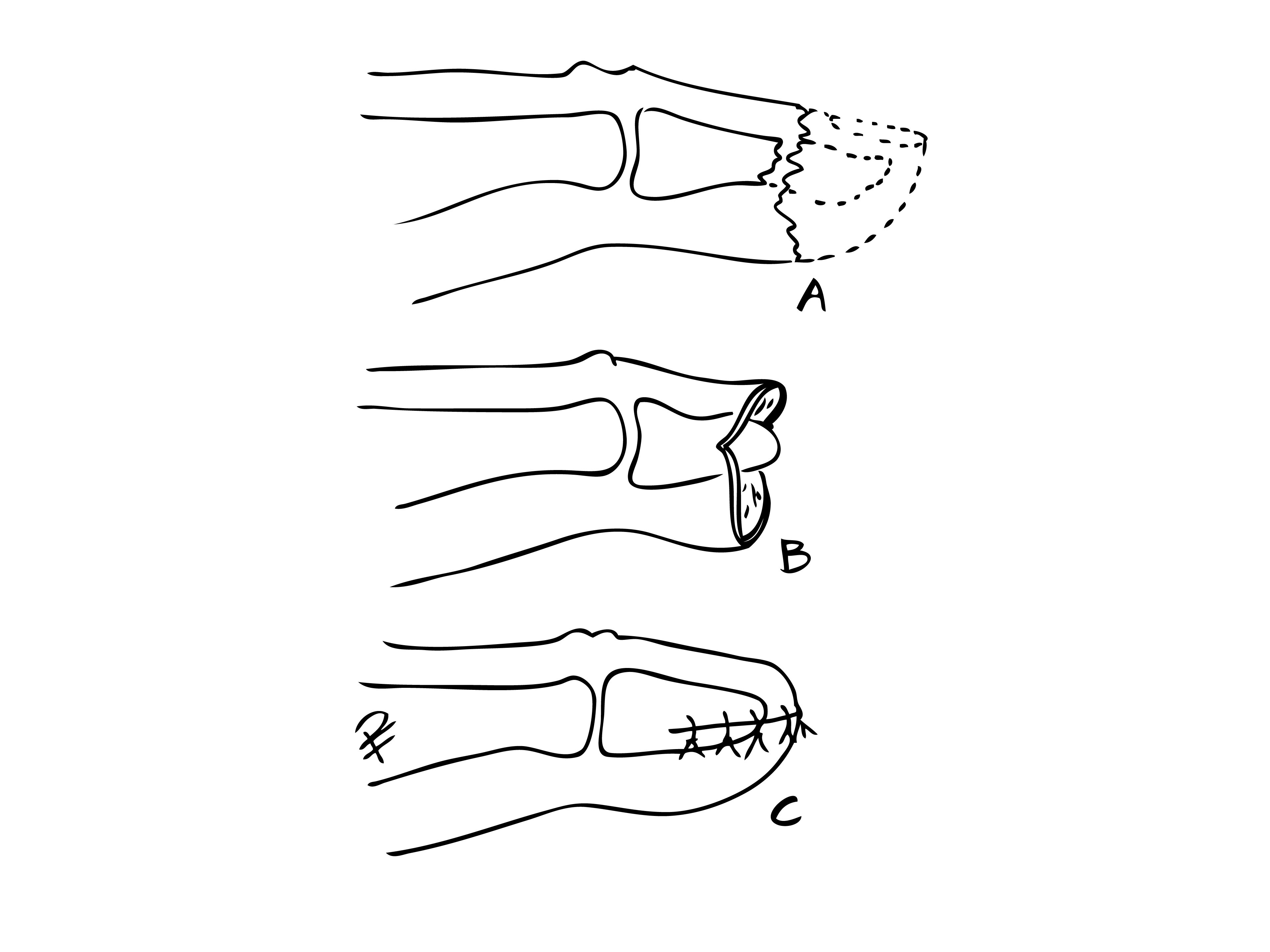 Illustration i svart och vit över fingertoppsskador, tecknat av Per Fredrikson