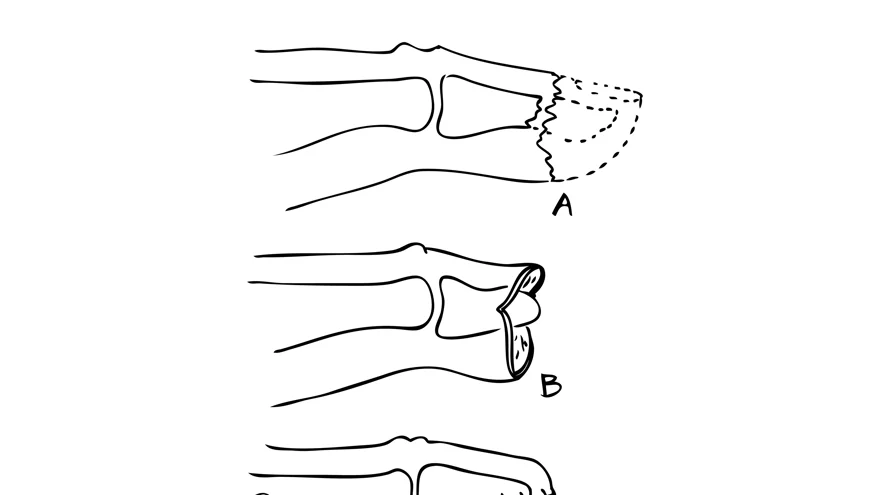 Illustration i svart och vit över fingertoppsskador, tecknat av Per Fredrikson