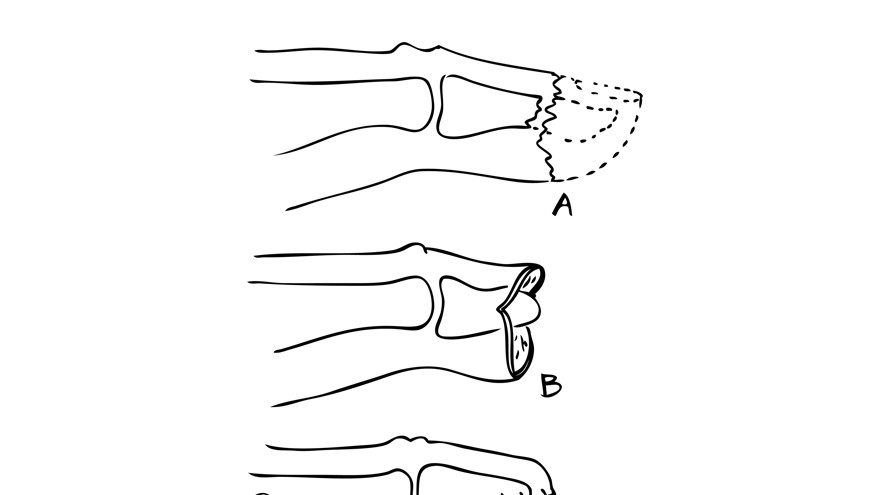 Illustration i svart och vit över fingertoppsskador, tecknat av Per Fredrikson