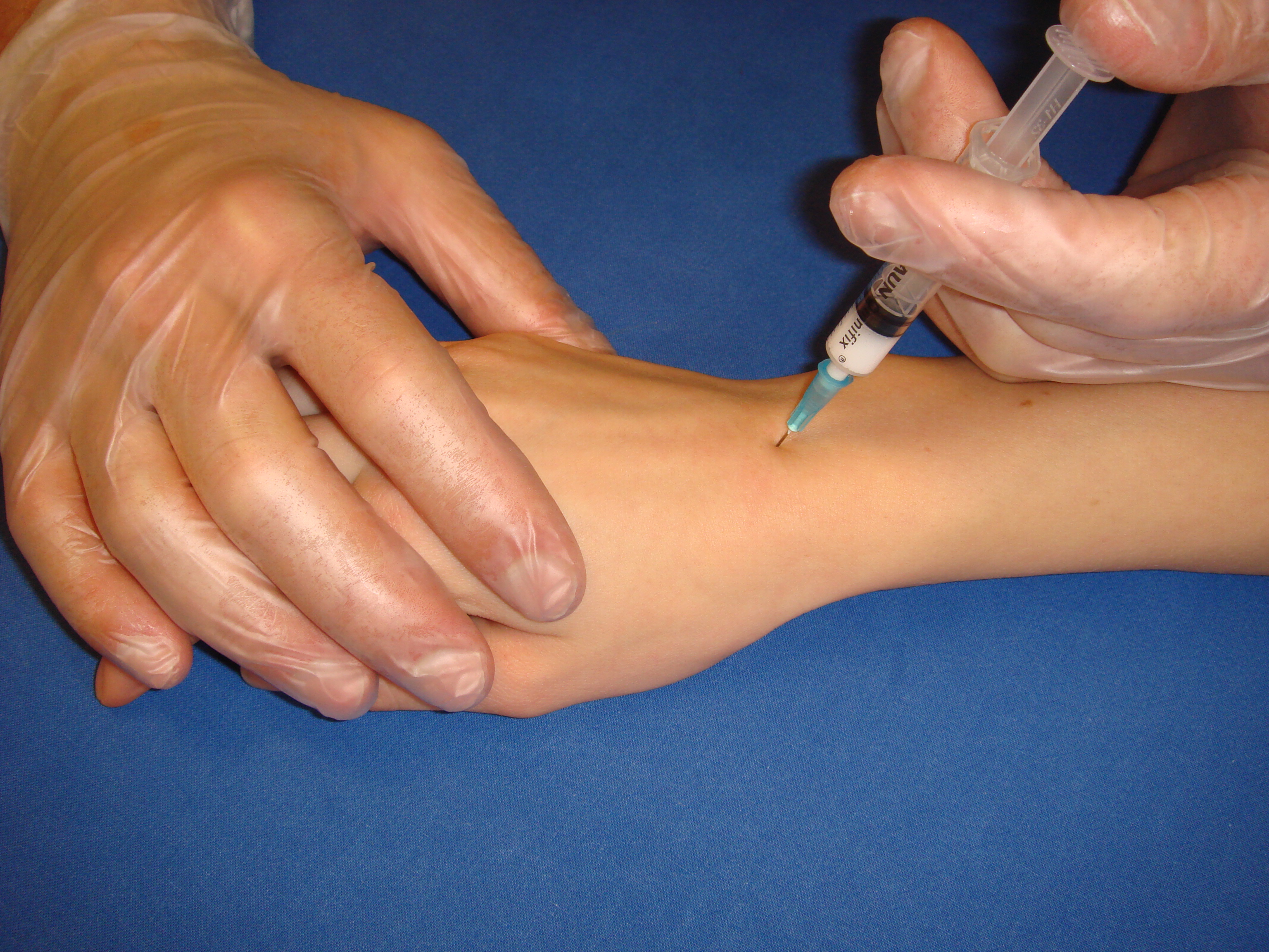 Handleden penetreras bäst från dorsal sidan då den är relativt fri från nerver och artärer.