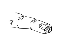 Svart och vit teckning över fingertoppsskada utan blottlagt ben.
