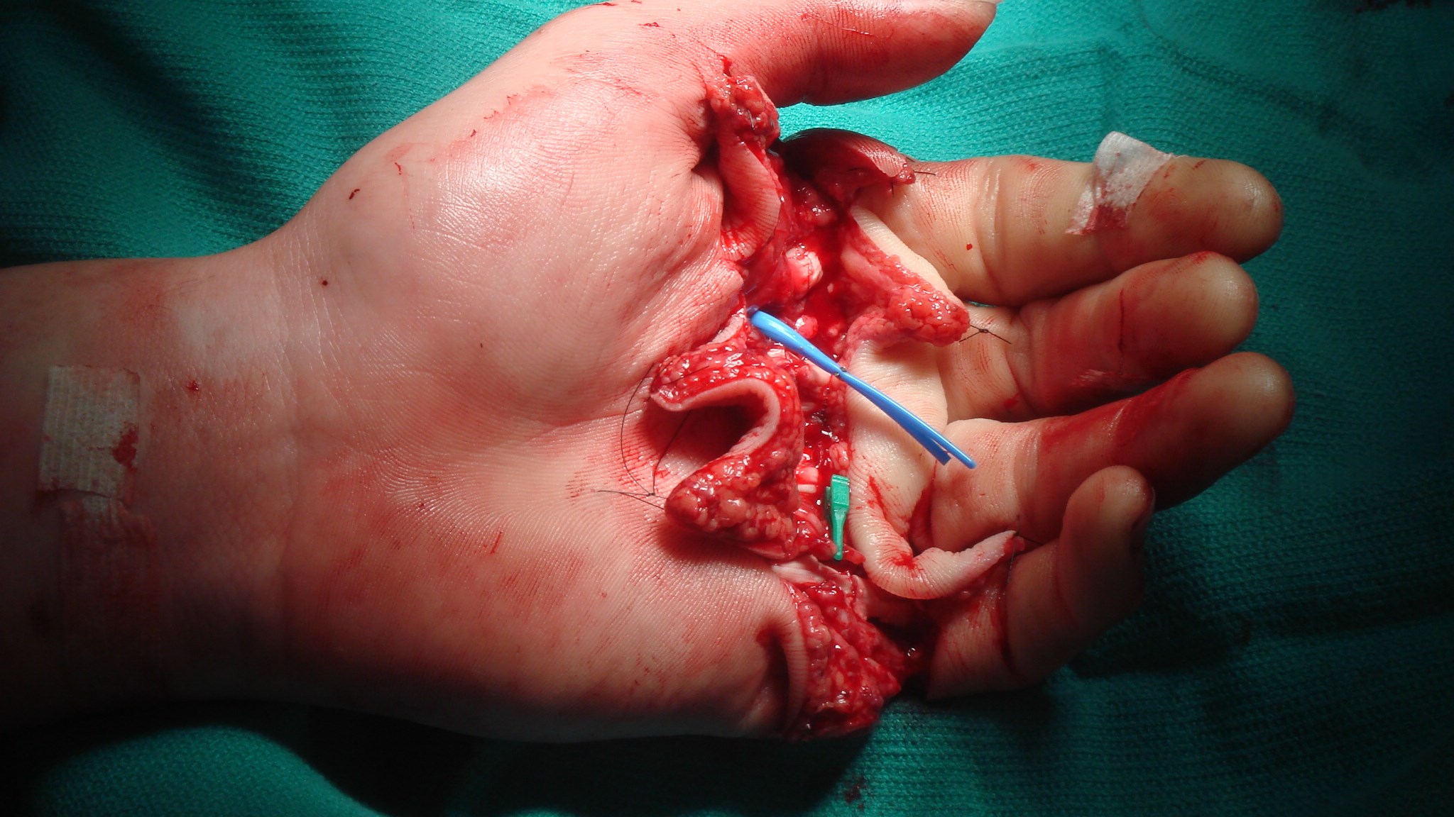 Handen replanterad, notera den fina färgen i amputatet tydande på fungerande cirkulation